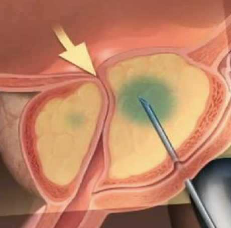 Biopsia de la Próstata