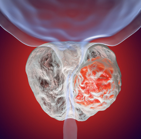 Cáncer de Próstata
