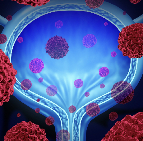 Cáncer de Vejiga