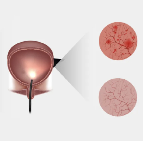 Cistitis Intersticial