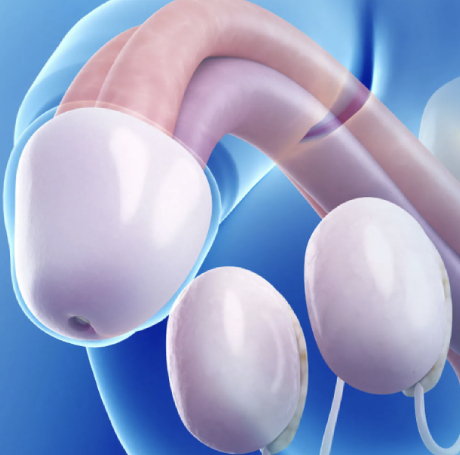 Disfunción Eréctil