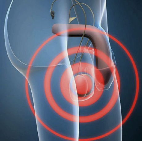 Enfermedades de los Testículos