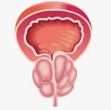 Hiperplasia Prostática Benigna