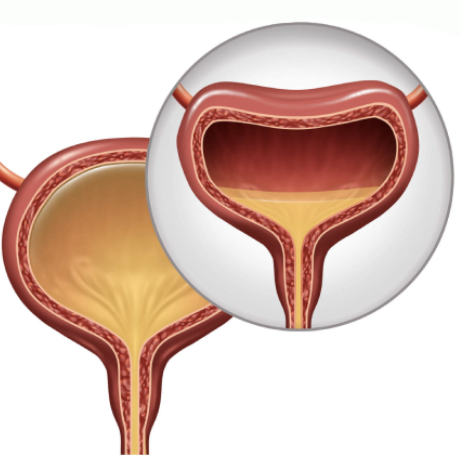 Incontinencia Urinaria