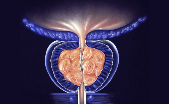 Enfermedades de Próstata